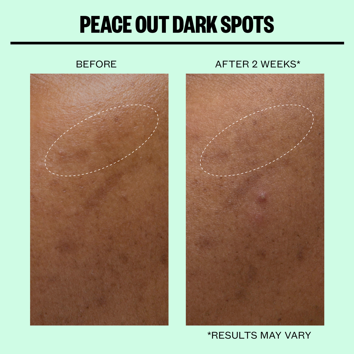 Peace Out Skincare - Dark Spots Microneedling Dots
