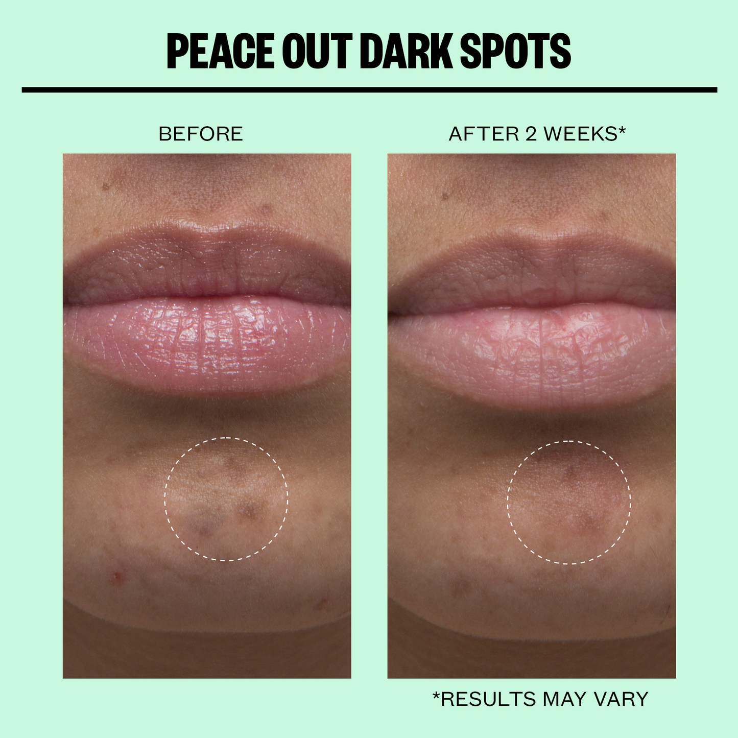 Peace Out Skincare - Dark Spots Microneedling Dots