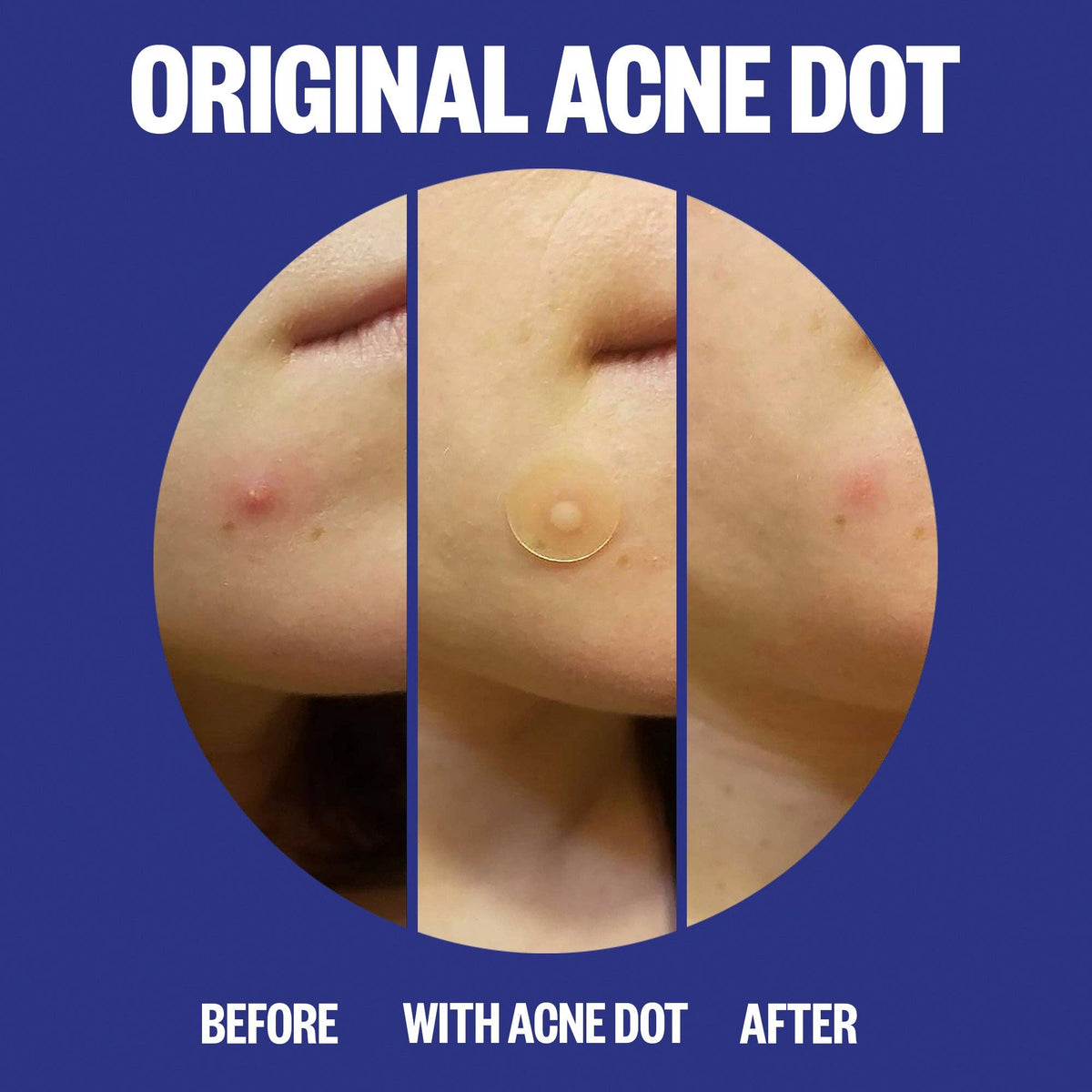 Peace Out Skincare - Acne Day & Night Duo